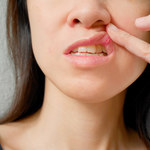 Afty - nieprzyjemne zmiany w jamie ustnej. Przyczyny, leczenie, domowe sposoby
