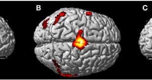 Aktywność mózgu podczas wizualizacji własnego ciała przez kobietę doświadczającą OOBE /materiały prasowe