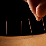 Akupunktura jak placebo
