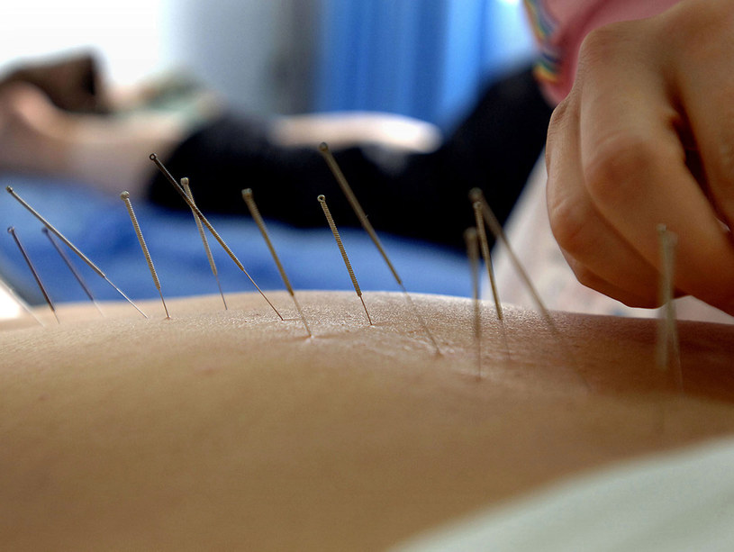 Akupunktura nie boli, jeśli igły wbija doświadczony specjalista &nbsp; /AFP