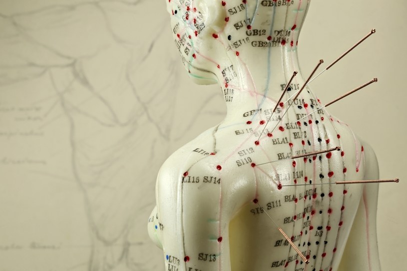 Akupunktura pomoże w odchudzaniu? Tak twierdzą japońscy badacze /123RF/PICSEL