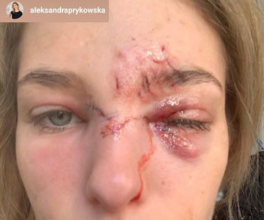Aleksandra Prykowska została pogryziona przez psa