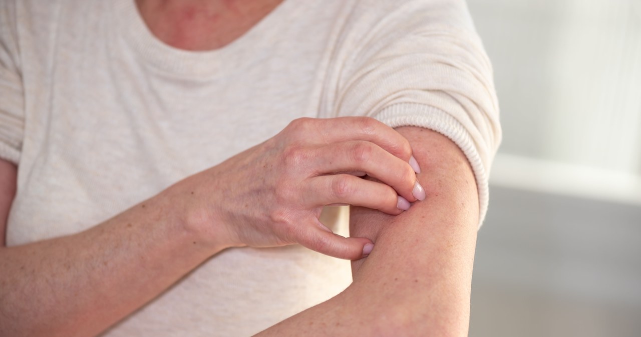 Alergia kojarzy się z niegroźną wysypką, jednak choroba może zagrażać zdrowiu, a nawet życiu /123RF/PICSEL