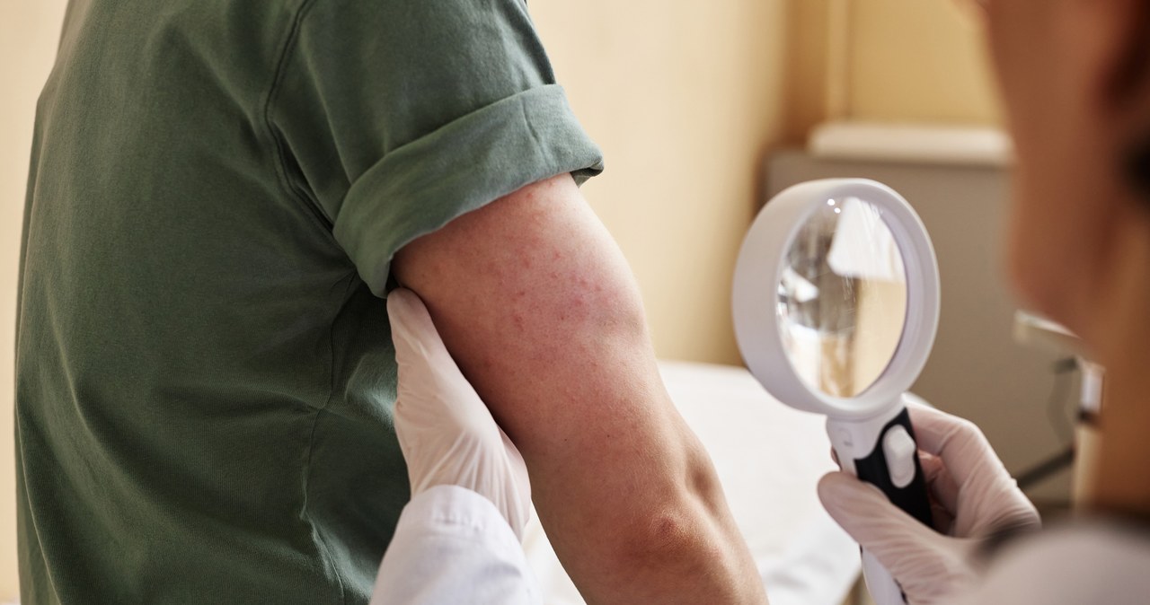 Alergia kojarzy się z niegroźną wysypką, jednak choroba może zagrażać zdrowiu, a nawet życiu /123RF/PICSEL