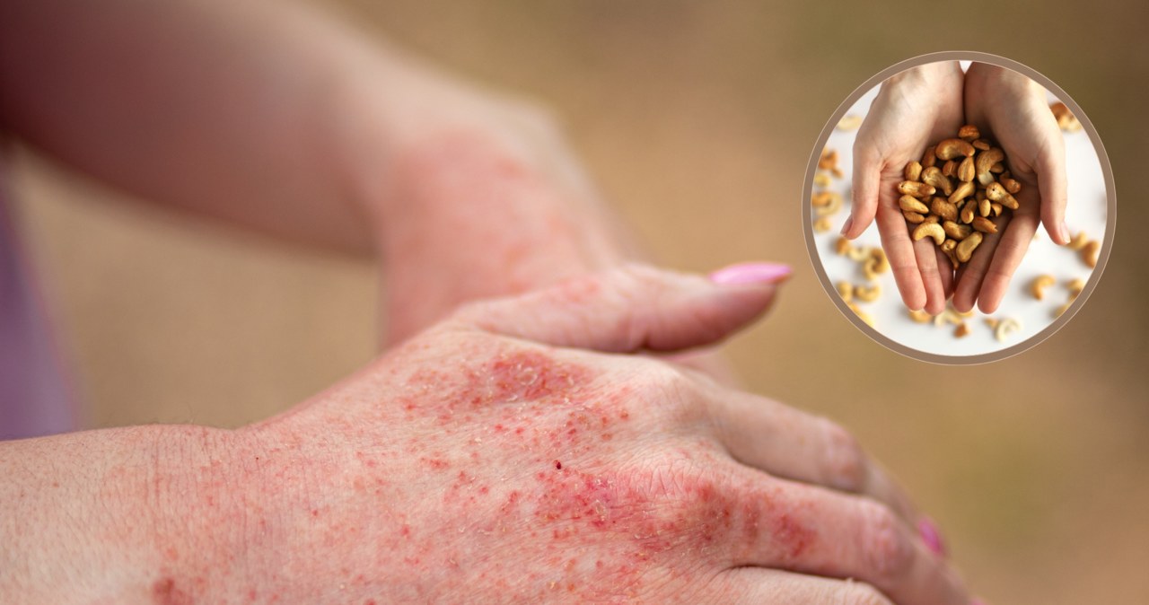 Alergia pokarmowa dotyka wielu osób. Co ją wywołuje? /Pixel
