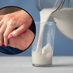 Alergia pokarmowa, którą zobaczysz na skórze. Lista produktów do wykluczenia jest długa