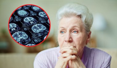 Alzheimer to cukrzyca typu trzeciego. Styl życia ma wpływ na mózg