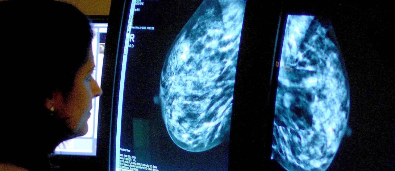 "Rak piersi to nie wyrok”