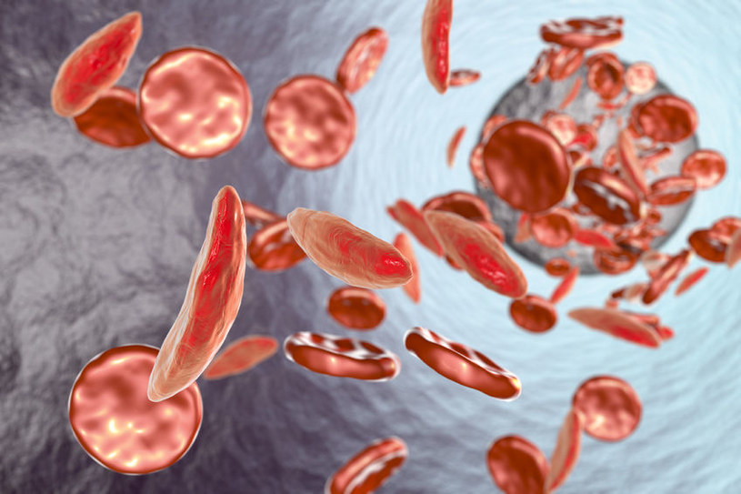 Anemia sierpowata to stan, w którym erytrocyty mają zakrzywiony, sierpowaty kształt /123RF/PICSEL