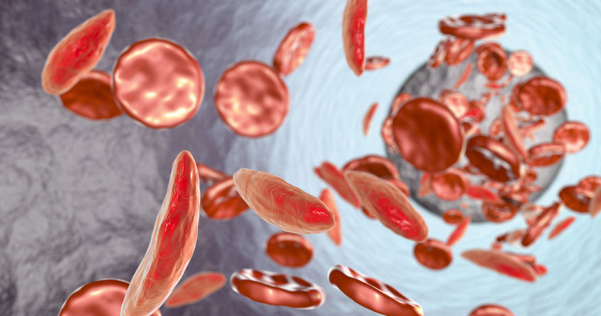 Anemia sierpowata to stan, w którym erytrocyty mają zakrzywiony, sierpowaty kształt /123RF/PICSEL