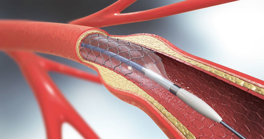 Angioplastyka /&copy;123RF/PICSEL