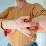 Pchły Ani komar, ani osa. To może być najbardziej bolesne ukąszenie tego lata