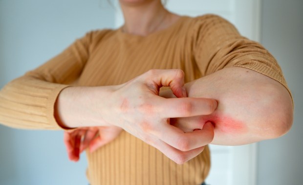 Ani komar, ani osa. To może być najbardziej bolesne ukąszenie tego lata