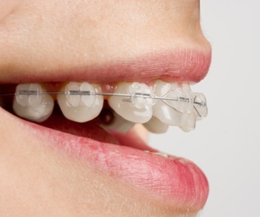 Aparat na zęby - rodzaje i użytkowanie