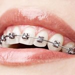 Aparat ortodontyczny 