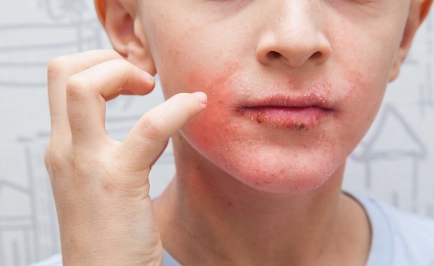 ​Apel o refundację leku dla dzieci z AZS. Jest darmowy tylko dla dorosłych