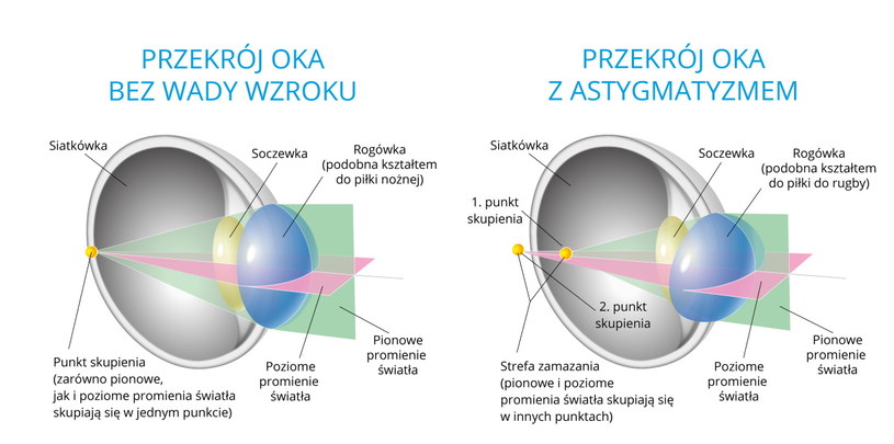Astygmatyzm to wada układu optycznego oka