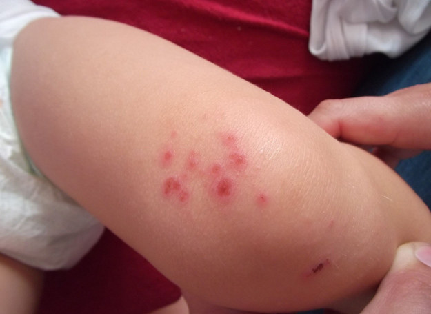 Atopowe zapalenie skóry jest chorobą o podłożu alergicznym. /123RF/PICSEL