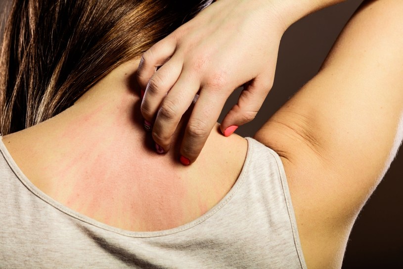 Atopowe zapalenie skóry może mocno dawać się we znaki! /123RF/PICSEL