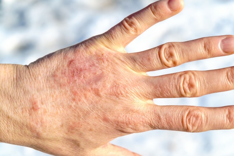 Atopowe zapalenie skóry to choroba, która leży w genach /123RF/PICSEL