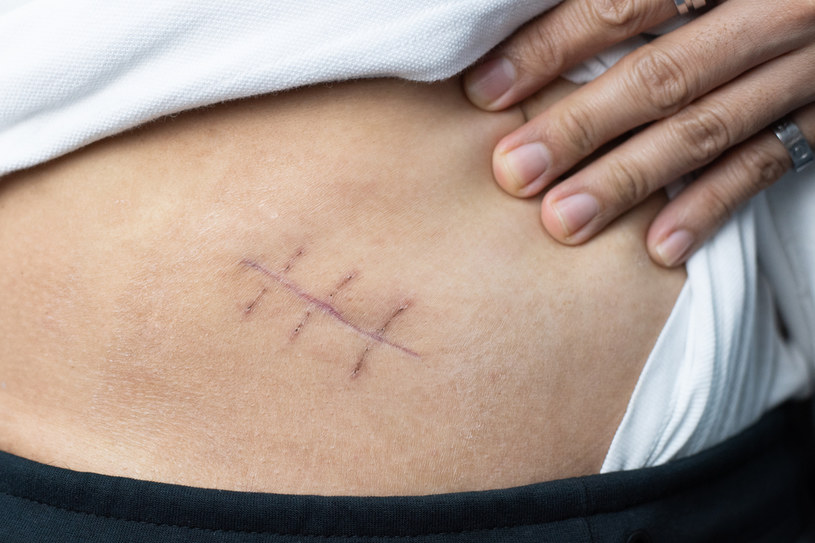 Aż 1/3 pacjentów po rozległej operacji w obrębie brzucha wróci na stół operacyjny ze zrostami /123RF/PICSEL