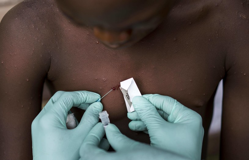 Badanie chłopca z charakterystycznymi dla małpiej ospy zmianami skórnymi na obecność wirusa, Kongo sierpień 2017 r. /Melina Mara/The Washington Post via Getty Images /Getty Images