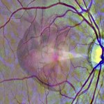 Badanie oka może przewidzieć atak serca