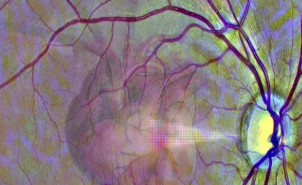 Badanie oka może przewidzieć atak serca