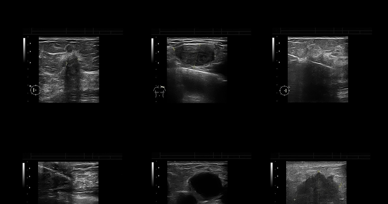 Badanie USG piersi powinno być refundowane /123RF/PICSEL