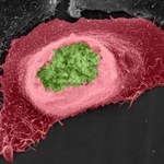 Bakterie odpowiedzialne za choroby weneryczne powodują raka?