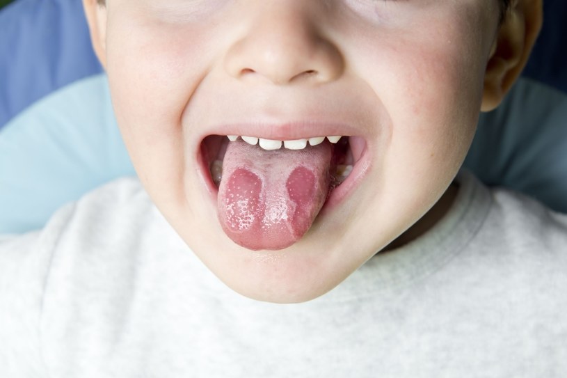 Bakterie żyją nie tylko na zębach, ale także na błonie śluzowej jamy ustnej /123RF/PICSEL