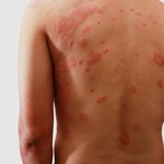 Bakteryjne zapalenie skóry - jak leczyć wstydliwą dolegliwość? 