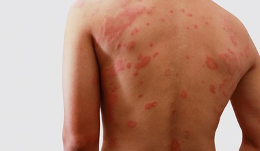 Bakteryjne zapalenie skóry - jak leczyć wstydliwą dolegliwość? 