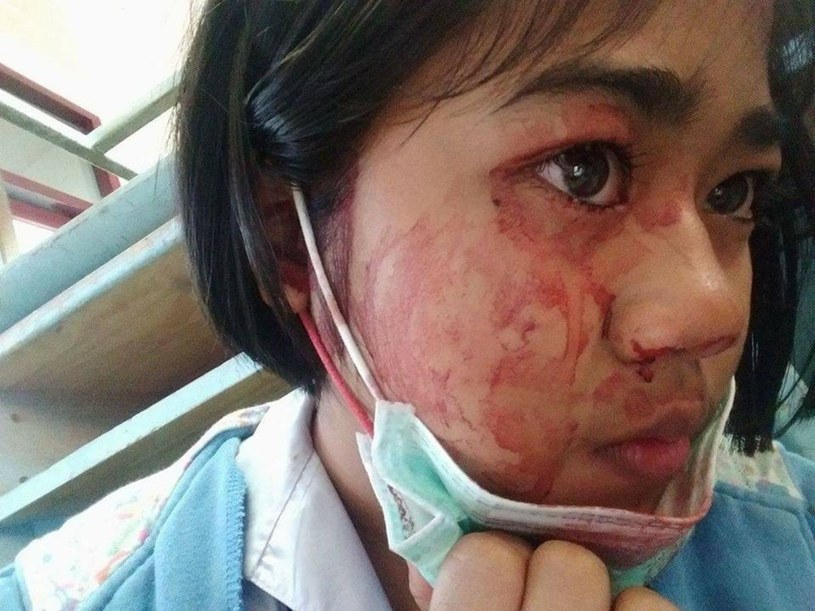 Bardzo podobny przypadek hematohydrozji, jaki wystąpił u 14-latki z Tajlandii. Fot. Exclusivepix Media/East News /East News