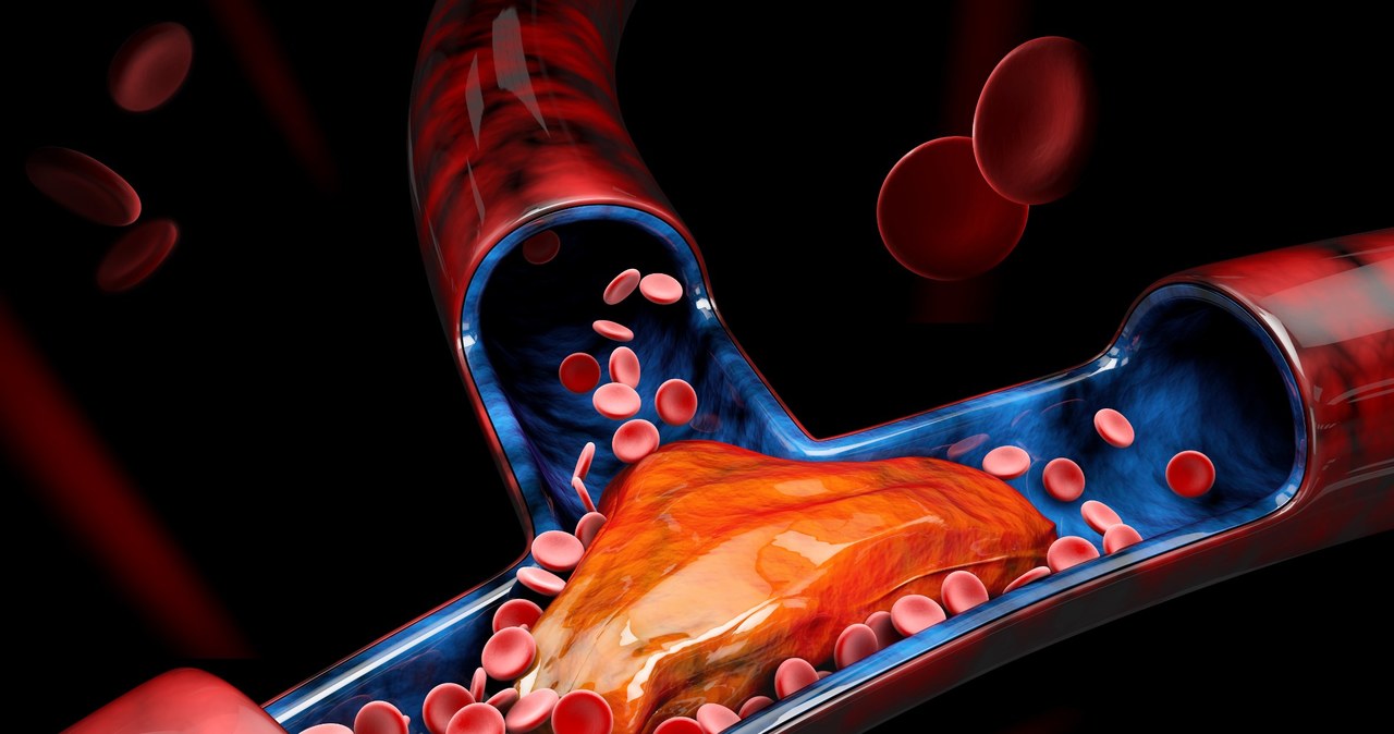 Bez cholesterolu niemożliwa byłaby synteza witaminy D3 i otoczki mielinowej komórek nerwowych, jest on zatem niezwykle ważny dla organizmu /123RF/PICSEL