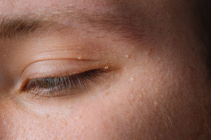 Białe grudki na twarzy - przyczyny powstawania, usuwanie