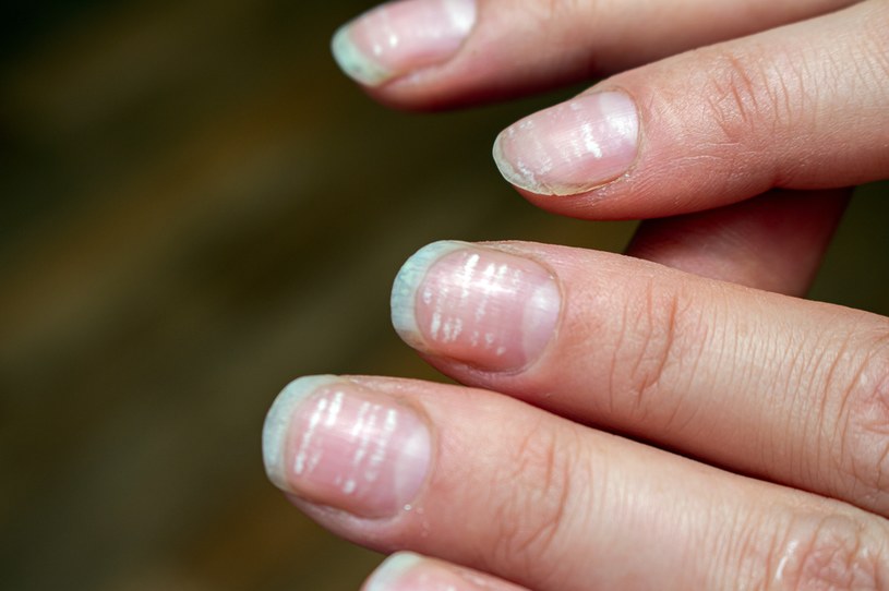 Białe plamki na paznokciach mogły powstać na skutek poważnej choroby. Warto z takimi paznokciami udać się do specjalisty /123RF/PICSEL