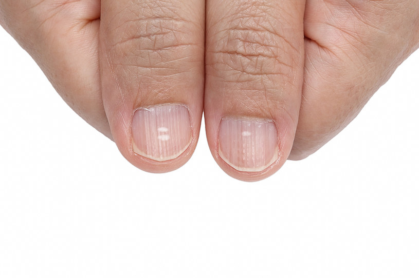 Białe plamki na paznokciach to znak, że cierpisz na niedobór minerałów i witamin /123RF/PICSEL