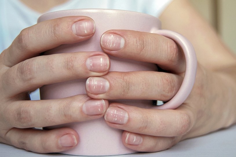 Białe plamy na paznokciach mogą być objawem choroby paznokci lub braku minerałów /123RF/PICSEL