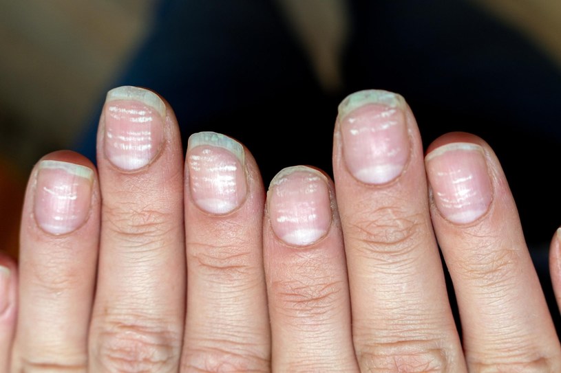 Białe plamy na paznokciach mogą świadczyć także o osłabionej odporności, niedoborach witamin, egzemie, chorobie nerek czy niedomaganiu wątroby /123RF/PICSEL