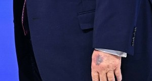 ​Biały Dom wydał oświadczenie ws. siniaka na dłoni Trumpa