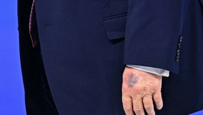 ​Biały Dom wydał oświadczenie ws. siniaka na dłoni Trumpa