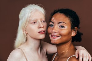 Bielactwo, czyli albinizm. Objawy i leczenie zaburzeń produkcji pigmentu 