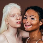 Bielactwo, czyli albinizm. Objawy i leczenie zaburzeń produkcji pigmentu 