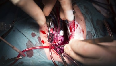 Błąd podczas operacji. Lekarz usunął pacjentowi zdrową nerkę 