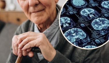 Blaszki amyloidowe w mózgu dają specyficzne objawy. To początek choroby Alzheimera