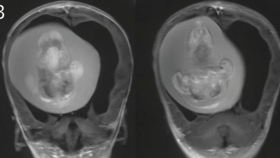 Bliźniak w mózgu dziecka. Miał 10 cm