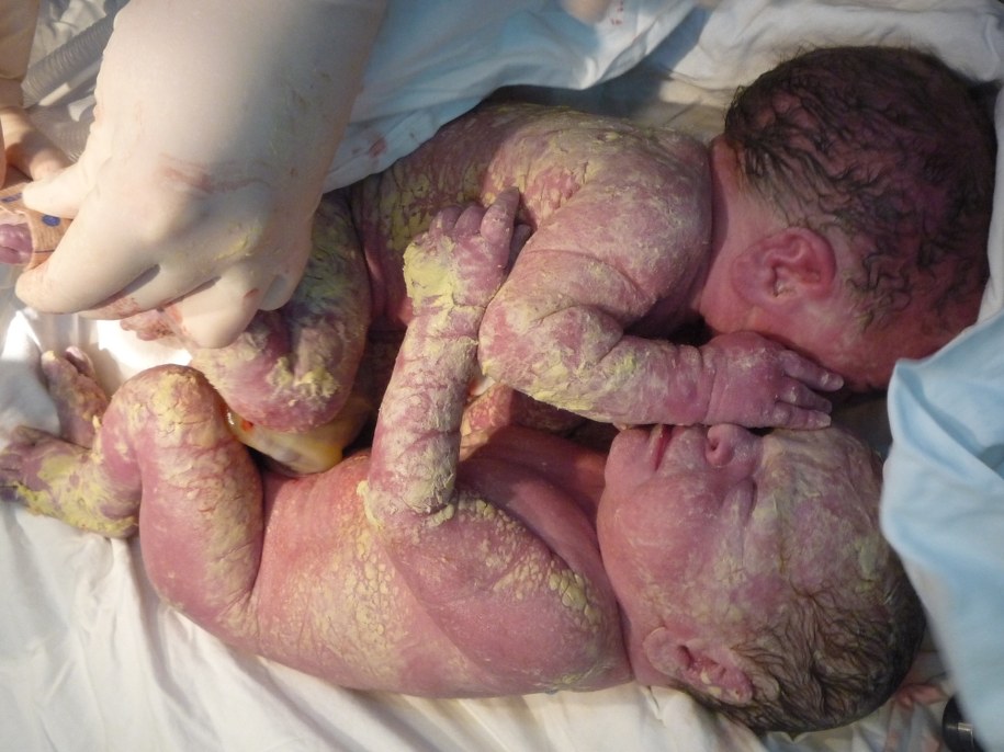 Bliźnięta przyszły na świat zrośnięte brzuszkami /Uniwersyteckie Centrum Zdrowia Kobiety i Noworodka WUM /PAP