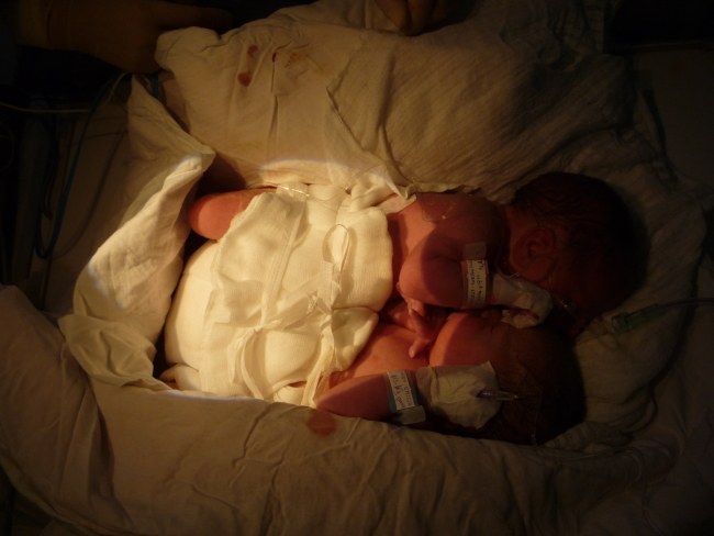 Bliźnięta syjamskie Jan i Dawid /PAP/Uniwersyteckie Centrum Zdrowia Kobiety i Noworodka WUM /PAP