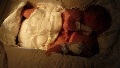 Bliźnięta syjamskie urodziły się w Warszawie